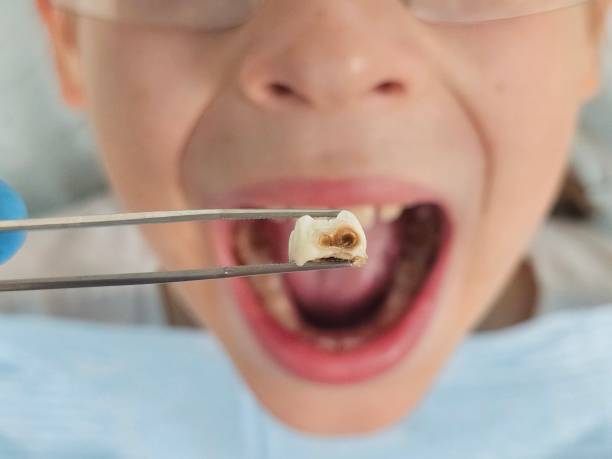 Best Emergency Treatment for Dental Infections or Abscesses in Avon, IN